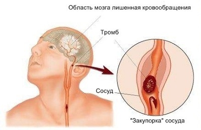 Consecințele accidentului cerebral ischemic