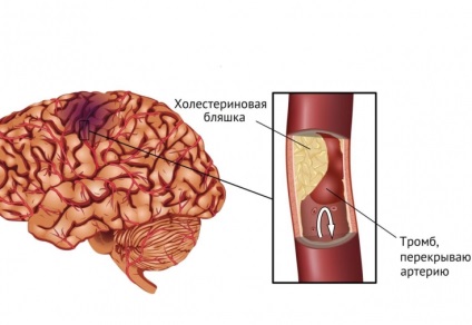 Implicații după un accident vascular cerebral de 10 mituri