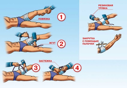Regulile pentru aplicarea unui turnichet în timpul sângerării și pentru cât timp poate fi impus