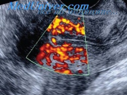Semne de sarcină cu dopplerografie de culoare
