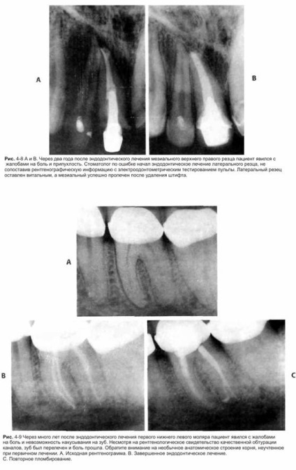 Prognoza tratamentului endodontic