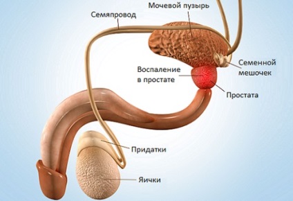 Contraindicații pentru prostatită la bărbați, care ar trebui să fie temut