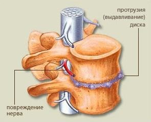 Protruzia discurilor coloanei vertebrale și tratamentul proeminențelor