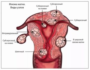 Caracteristicile fibroame uterine cardiace ale dezvoltării, diagnosticului și tratamentului