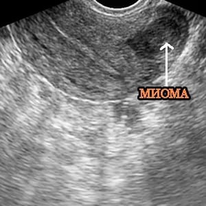 Caracteristicile fibroame uterine cardiace ale dezvoltării, diagnosticului și tratamentului