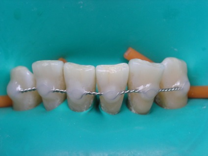 Shinning teeth - mi ez a fotó előtt és után, a betegek véleménye és költségei, anyagai és technológiája