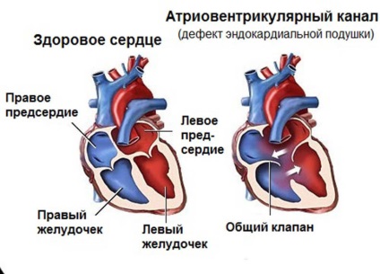 Zgomote în inimă