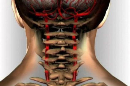 Sindromul arterei vertebrale cu tratament și simptome de osteochondroză cervicală