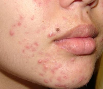 Gradul mediu de acnee, cum să scapi de acnee