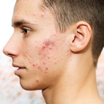 Gradul mediu de acnee, cum să scapi de acnee