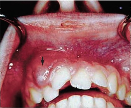 Stomweb - cikk - terv készítése endodontikus kezelésre