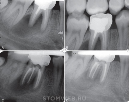 Stomweb - cikk - terv készítése endodontikus kezelésre