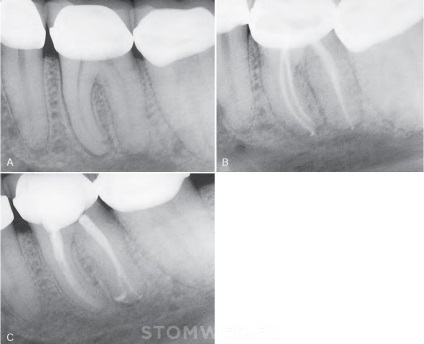 Stomweb - cikk - terv készítése endodontikus kezelésre