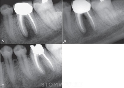 Stomweb - articol - elaborarea unui plan de tratament endodontic