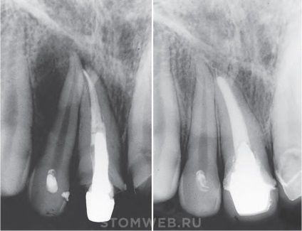 Stomweb - cikk - terv készítése endodontikus kezelésre