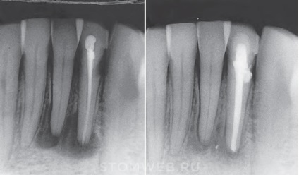 Stomweb - cikk - terv készítése endodontikus kezelésre