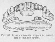 Coroane telescopice, stomatologie ortopedică