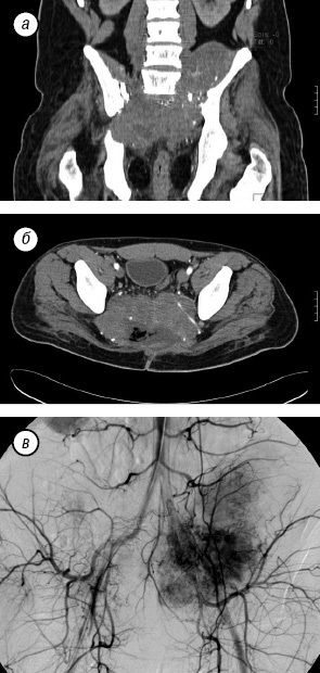 A sacrum teljes eltávolítása tumoros sérülésben, klinikai onkológia