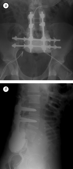 A sacrum teljes eltávolítása tumoros sérülésben, klinikai onkológia