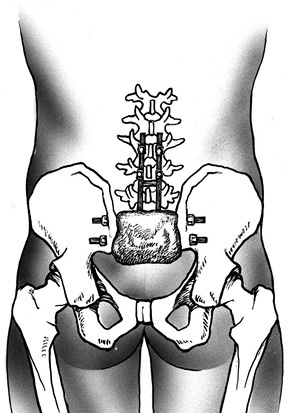 A sacrum teljes eltávolítása tumoros sérülésben, klinikai onkológia