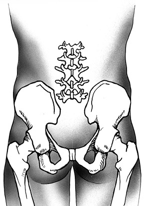 A sacrum teljes eltávolítása tumoros sérülésben, klinikai onkológia