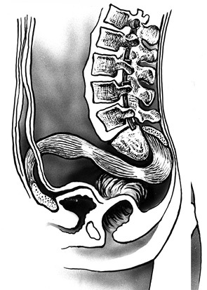 Eliminarea totală a sacrului în leziunea tumorală, oncologie clinică