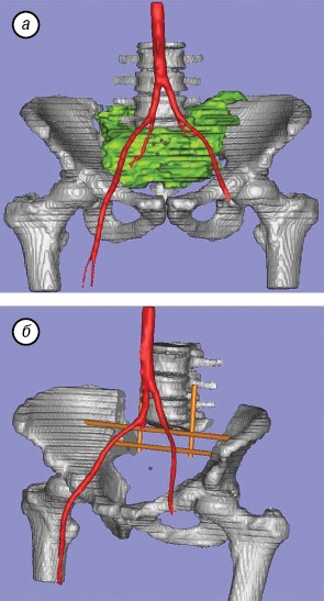 A sacrum teljes eltávolítása tumoros sérülésben, klinikai onkológia