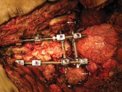 A sacrum teljes eltávolítása tumoros sérülésben, klinikai onkológia