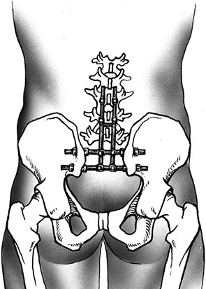 A sacrum teljes eltávolítása tumoros sérülésben, klinikai onkológia