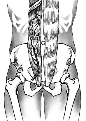 A sacrum teljes eltávolítása tumoros sérülésben, klinikai onkológia