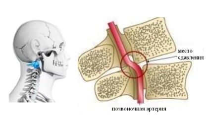 A fej remegése a nyaki osteochondrosis tüneteivel és kezelésével