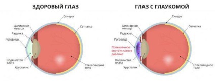 A retina központi vénás trombózisa
