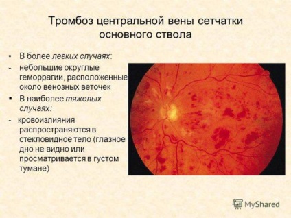 Központi vénás thrombosis retina kezelés és tünetek