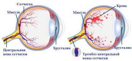 Központi vénás thrombosis retina kezelés és tünetek