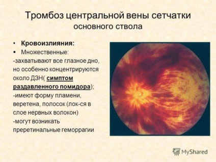 A retina központi vénás trombózisa