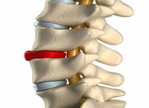 Eliminarea unui disc intervertebral herniat - prețuri, normă, decodificare, pregătire, contraindicații