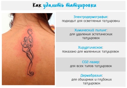 Îndepărtarea tatuajelor - rezultate, riscuri și metode (laser, creme, dermabraziune