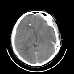 Brain ultrasunete pentru detectarea patologiilor