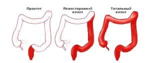 Tipuri de colită - informații generale