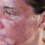 Tipurile de peeling al feței