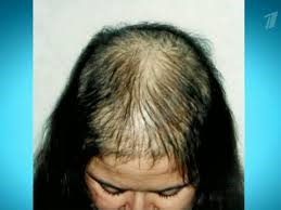 Căderea părului la femei, cauze