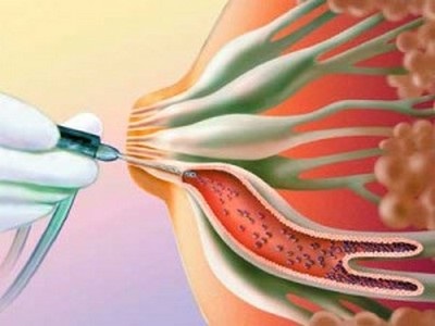 Intr-un flux de papilloma a glandei mamare poate fi vindecat cât mai curând posibil