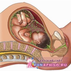 Tratamentul intrauterin al defectelor cardiace