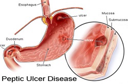 Ulcerul peptic - o nouă privire la vechea problemă