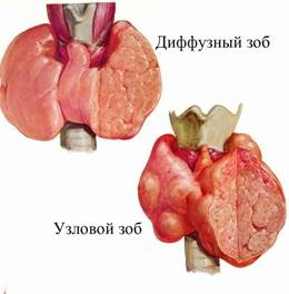 Afecțiuni ale glandelor tiroide