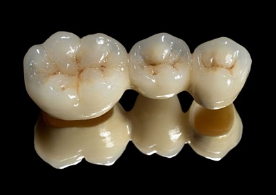 Coroane dentare