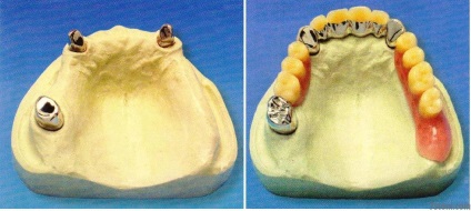 Protezele dentare și tipurile acestora