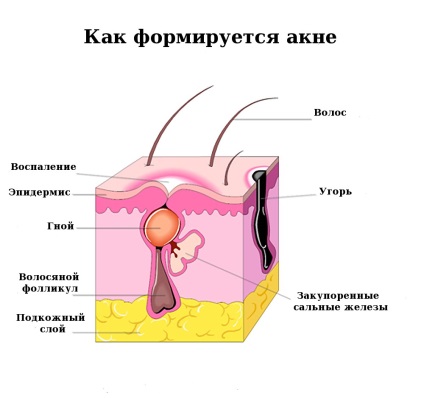 Akne - a betegség kezelése