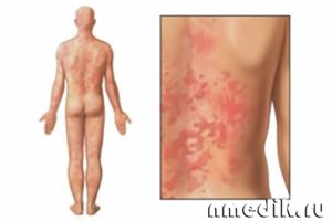 Bolile alergice și tratamentul acestora