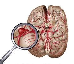 Anevrismul simptomelor creierului și consecințele, tratamentul și prevenirea